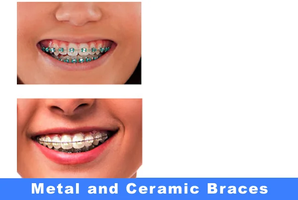 Metal and Ceramic Braces